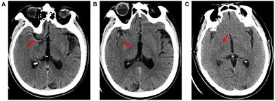 Prediction model of early biomarkers of massive cerebral infarction caused by anterior circulation occlusion: Establishment and evaluation